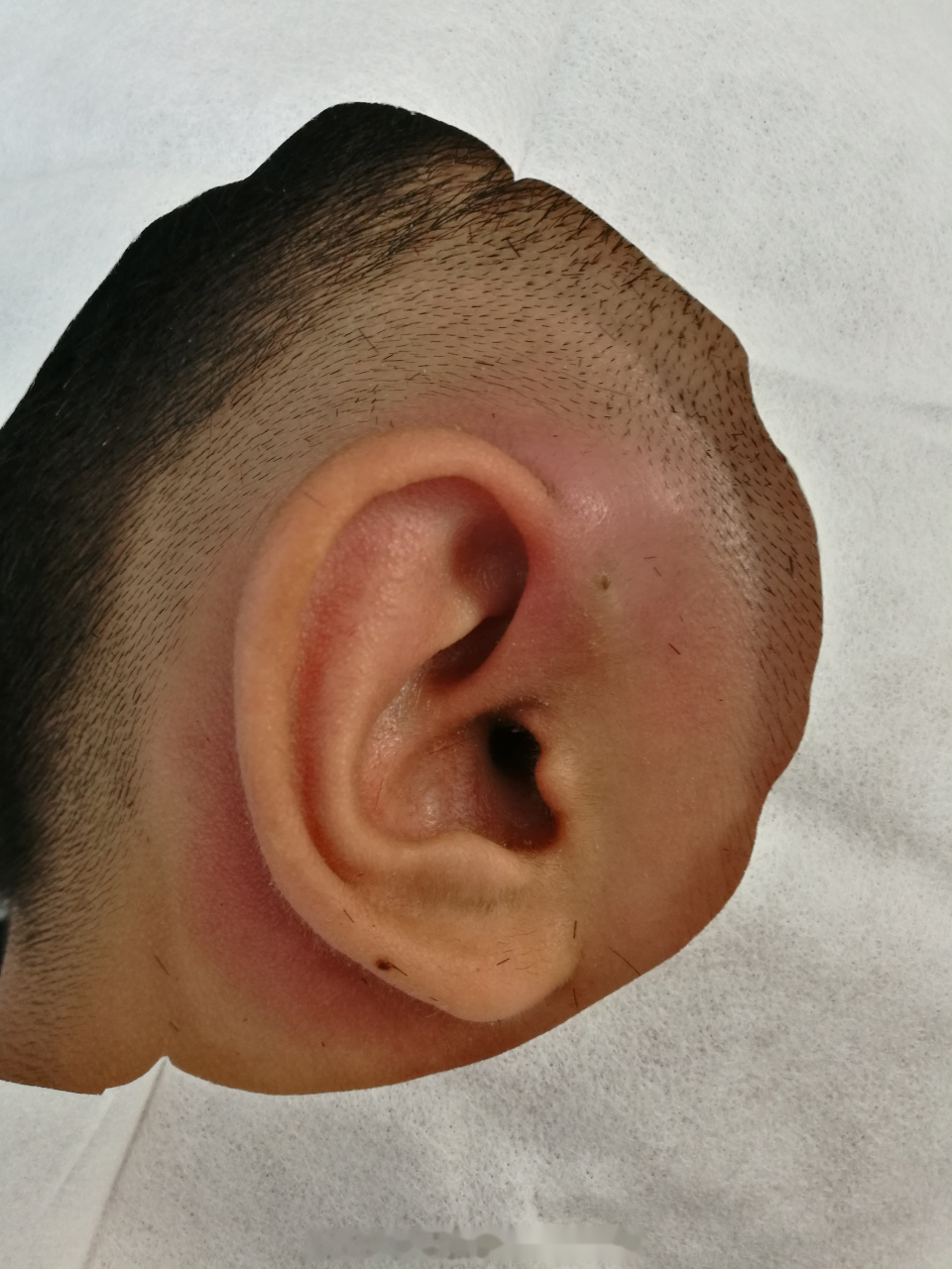 同事的孩子,双侧先天性耳前瘘管,左侧反复形成脓肿,去年切除后平安无
