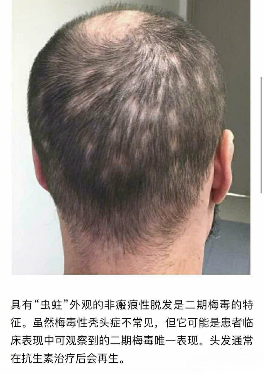 梅毒性斑秃图片