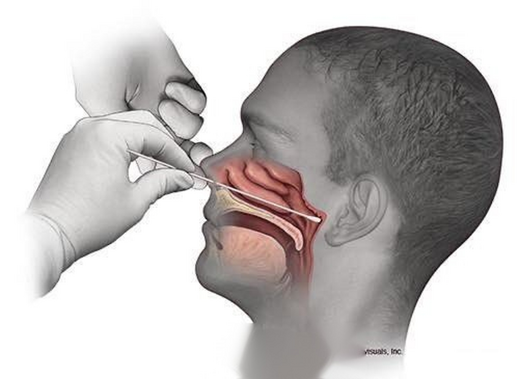 新冠肺炎鼻咽拭子测试需要捅这么深,然后在鼻内停留15~30秒并轻轻转动