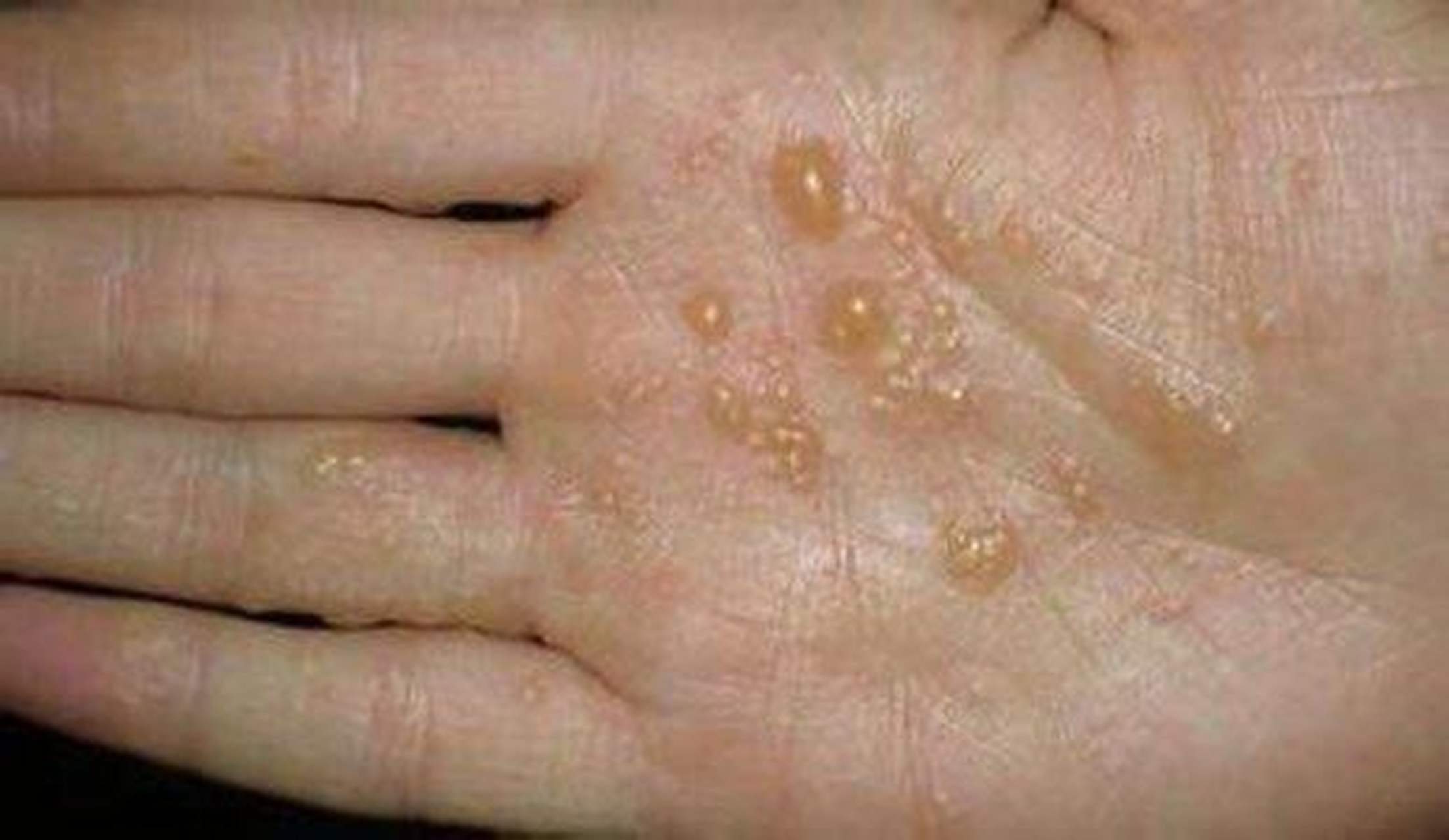 【夏天满手长了透明的小水泡是咋回事?又痒又难看,这该怎么办?