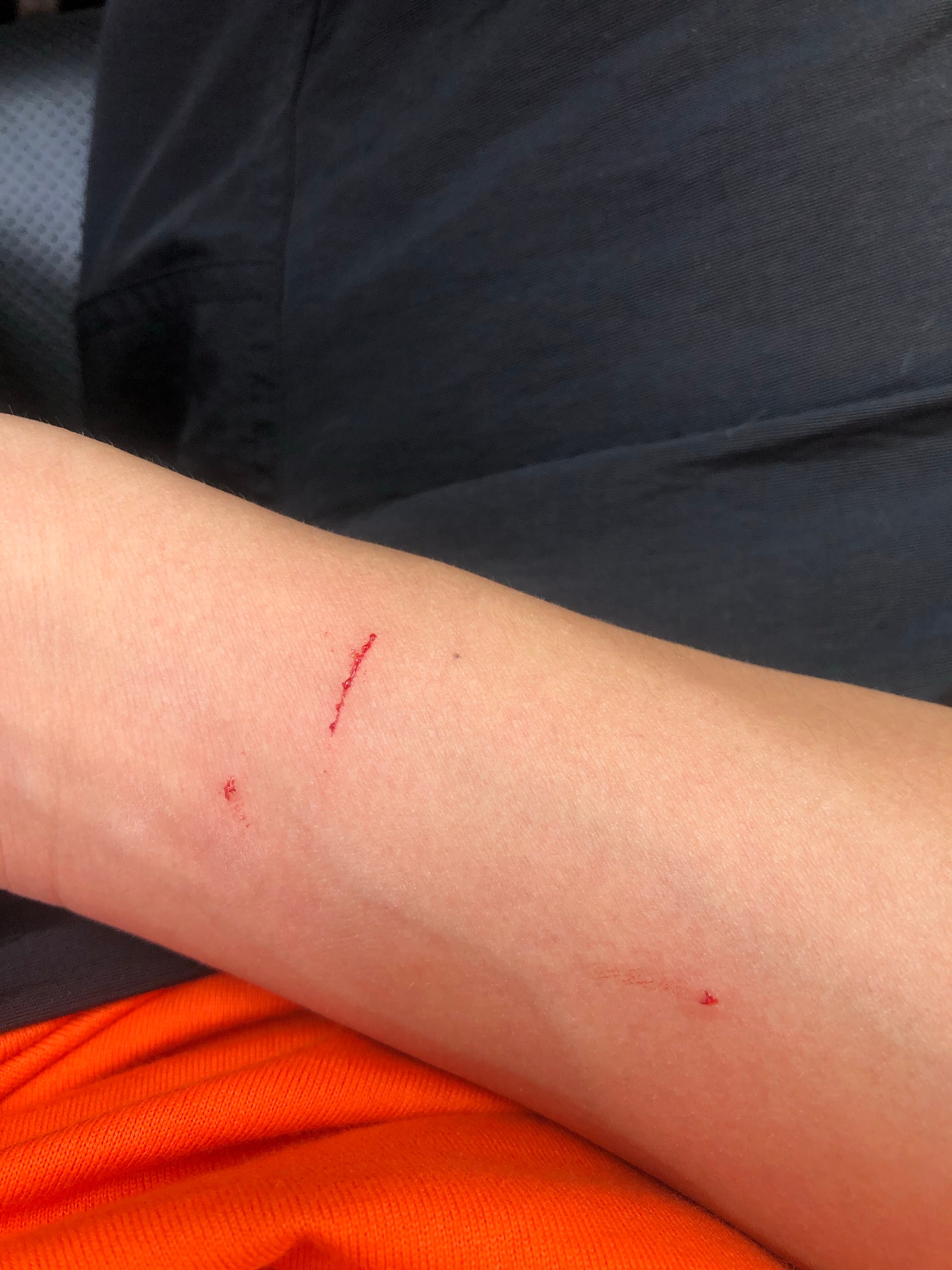 在线问:被家里的猫爪伤,用不用去医院打针