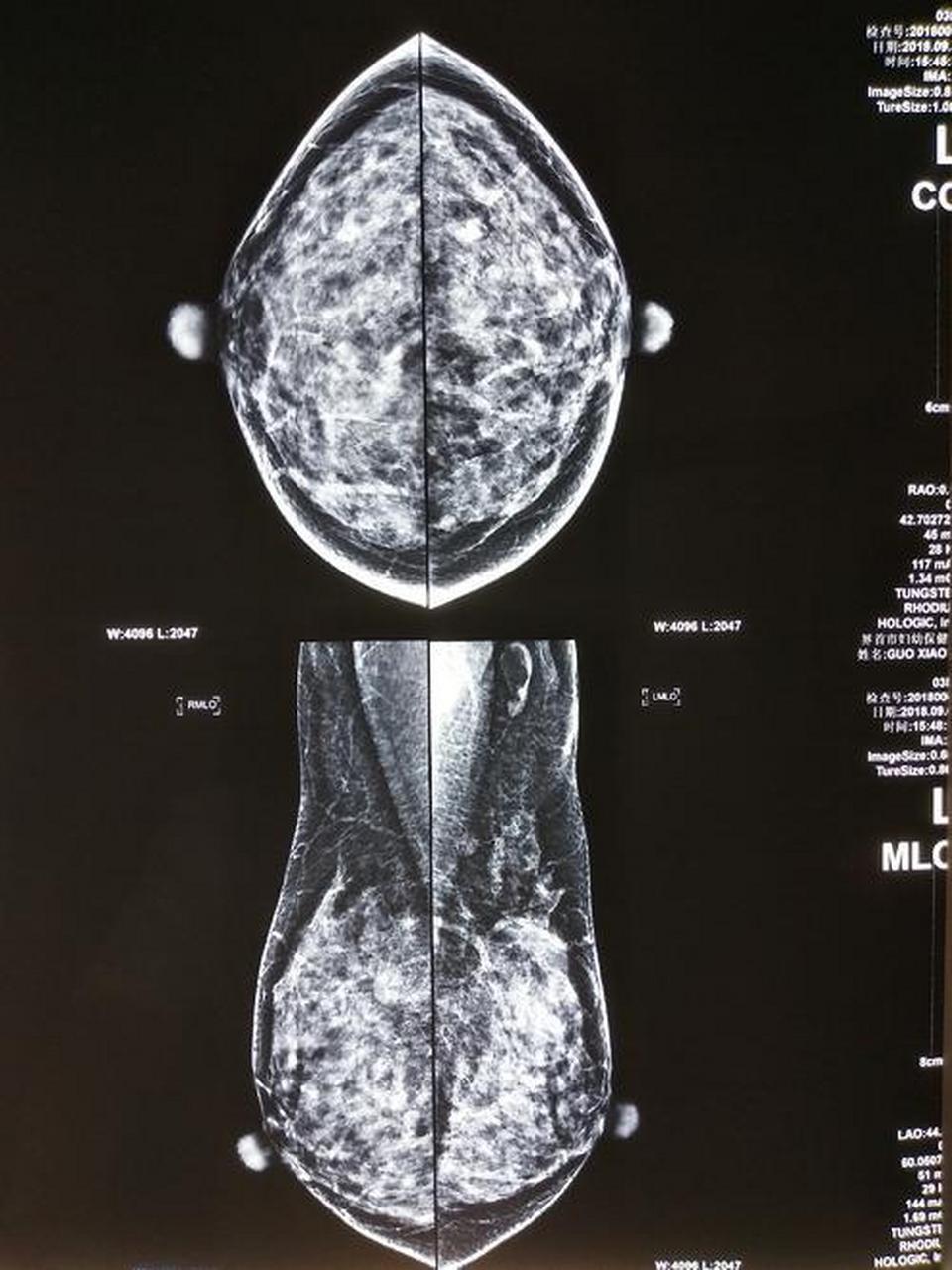 乳腺照片和乳腺钼靶图片