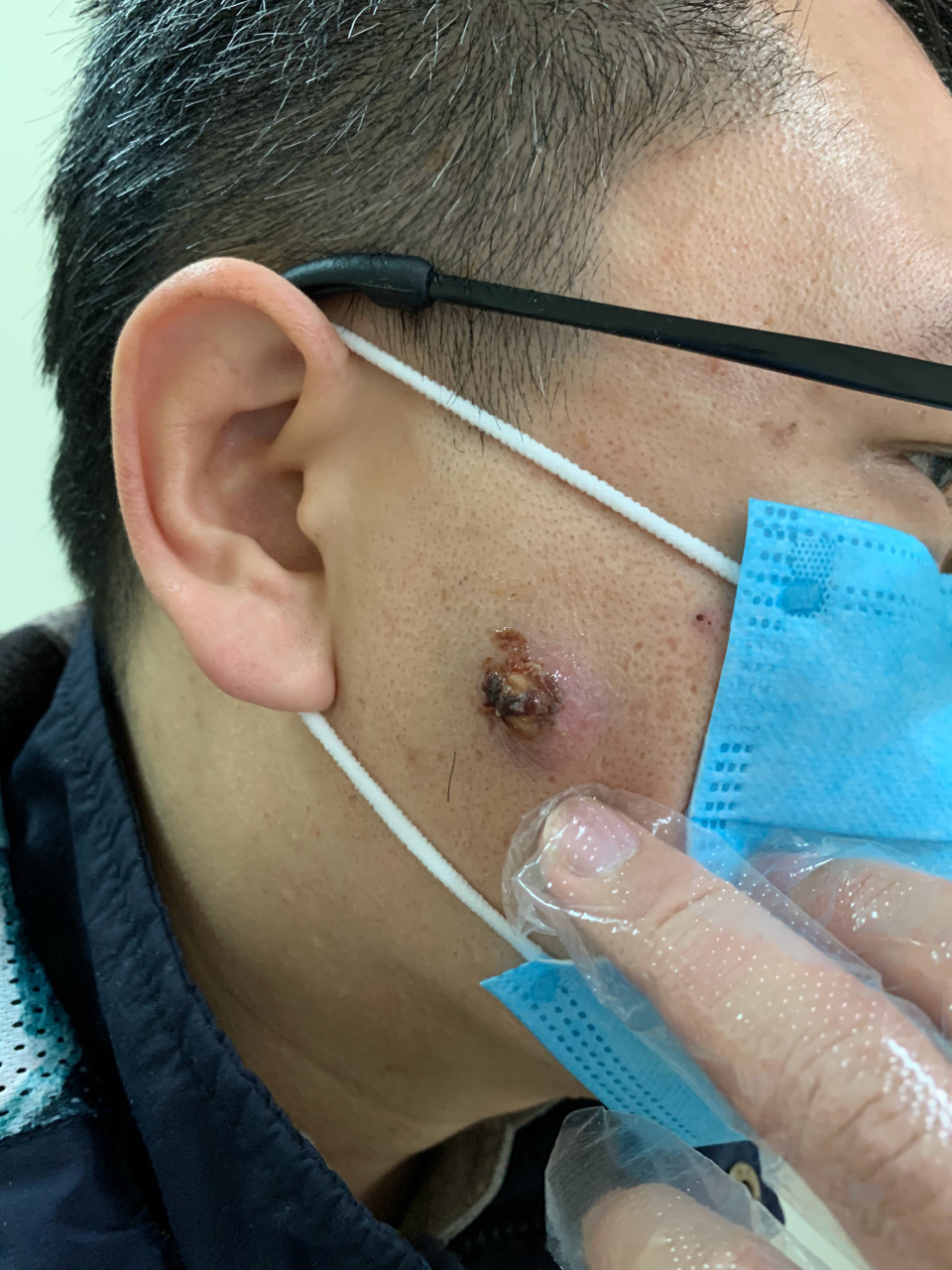 脸上的皮脂腺囊肿感染了,我建议他去整形科手术,疤痕小,美观一点!