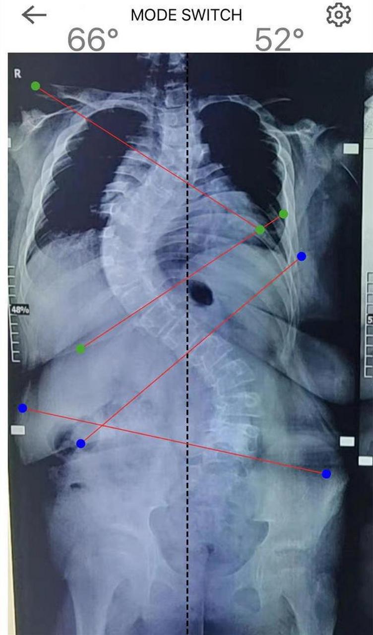 姗姗是一名prader-willi综合征(俗称小胖威利综合征,简称pws)患儿,3个