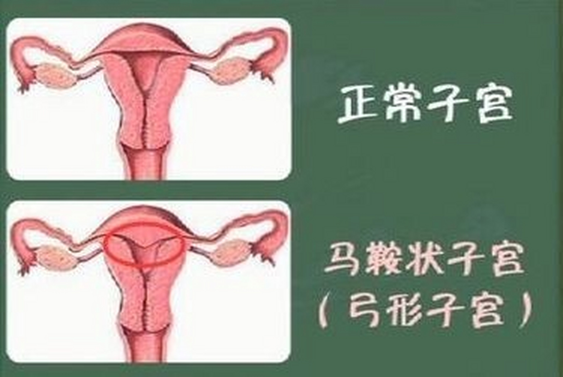 鞍形子宫图片