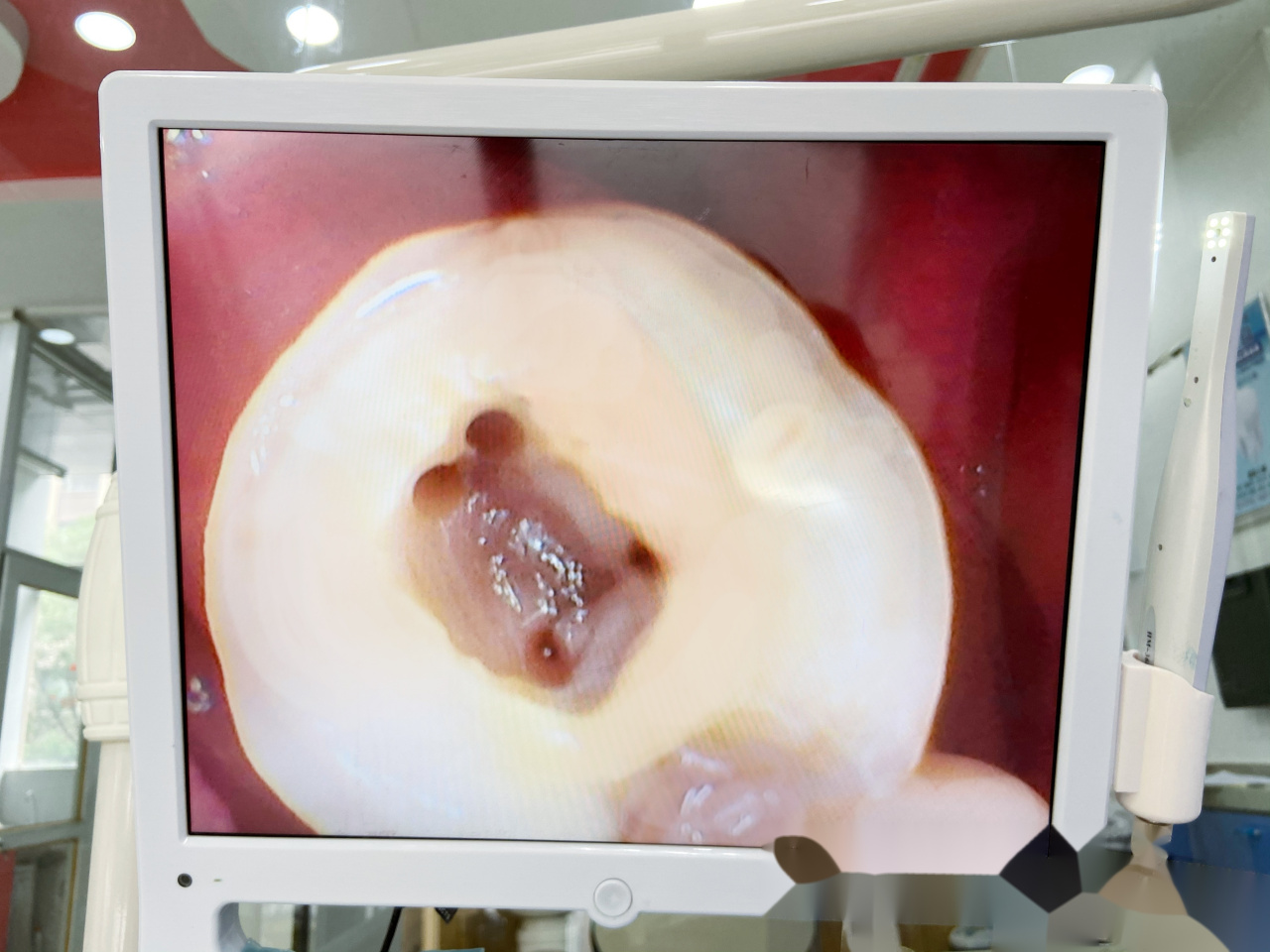 钻了四根牙神经[惊哭][惊哭]