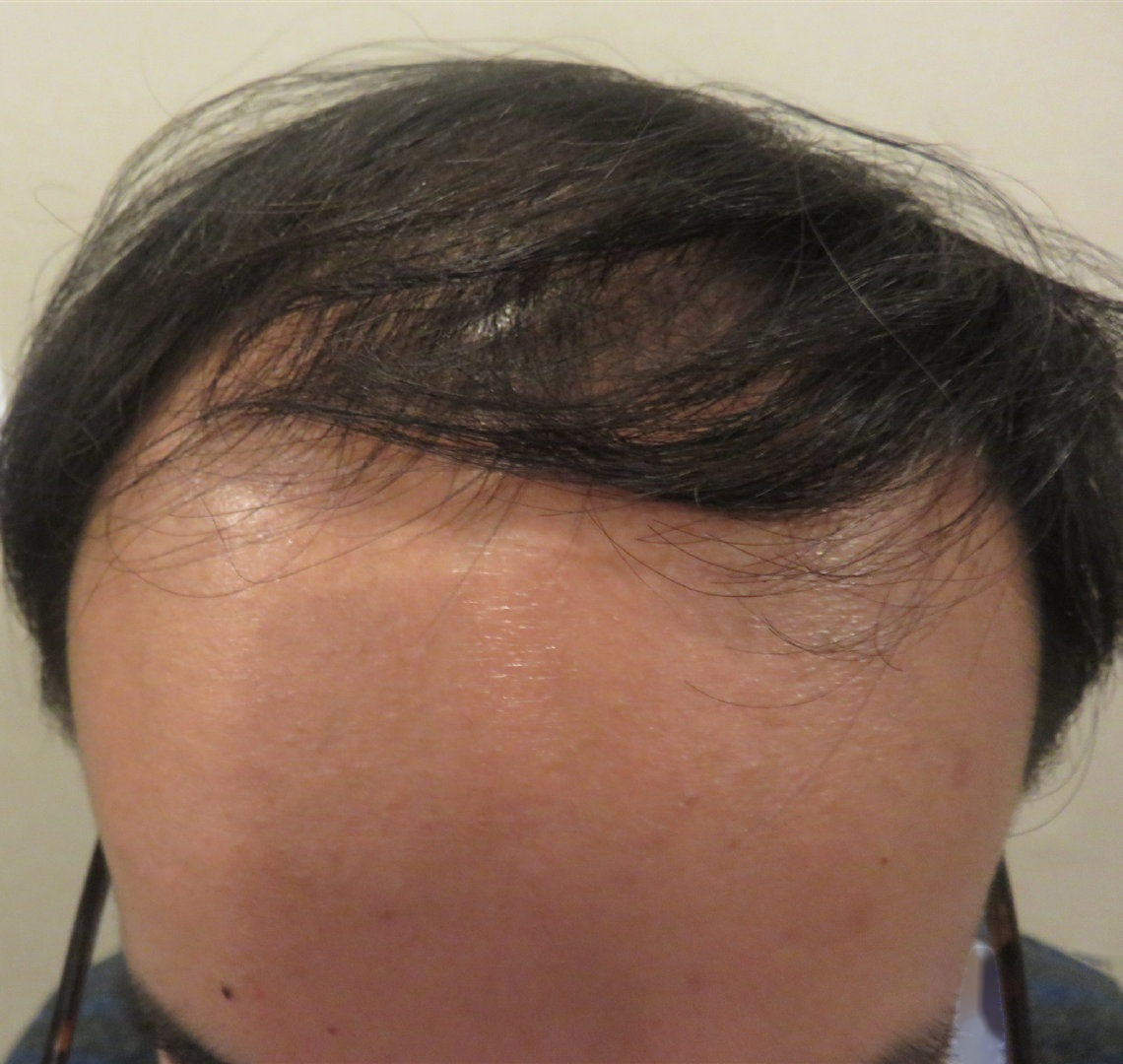 我的发际线严重的后移,经常被别人嘲笑大脑门,最主要还对我的形象有