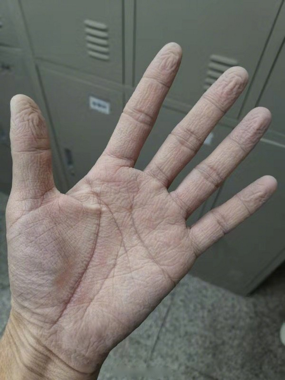 这是抗疫一线90后护士的手】这是一位90后男护士的手