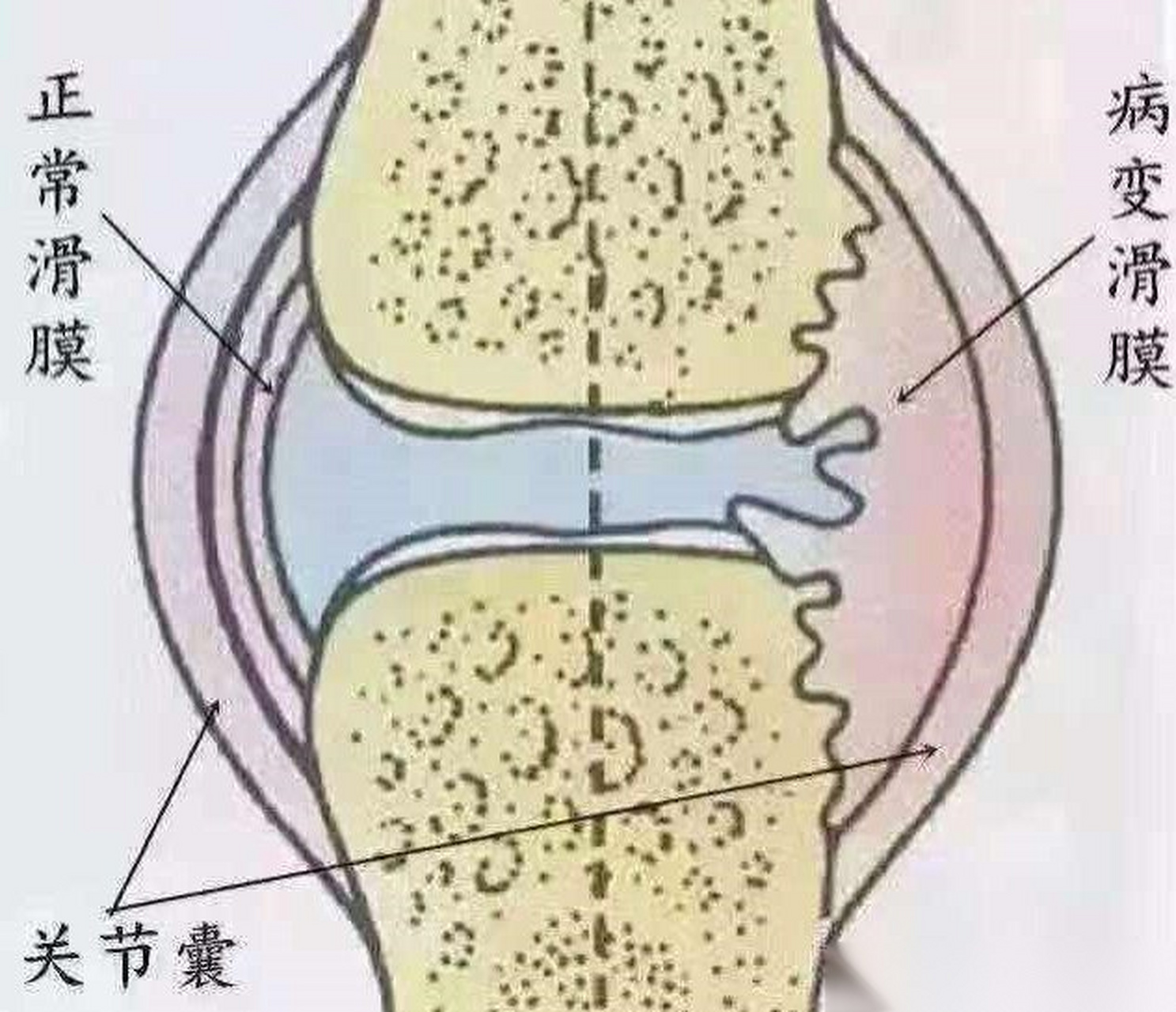膝关节有积液用不用手术?