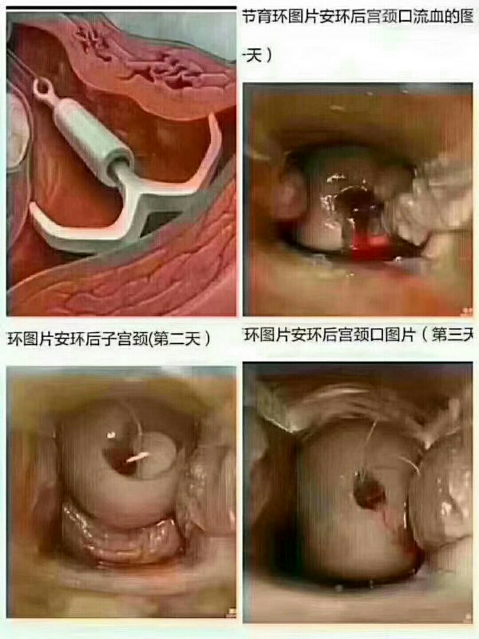 新型m节育环图片图片