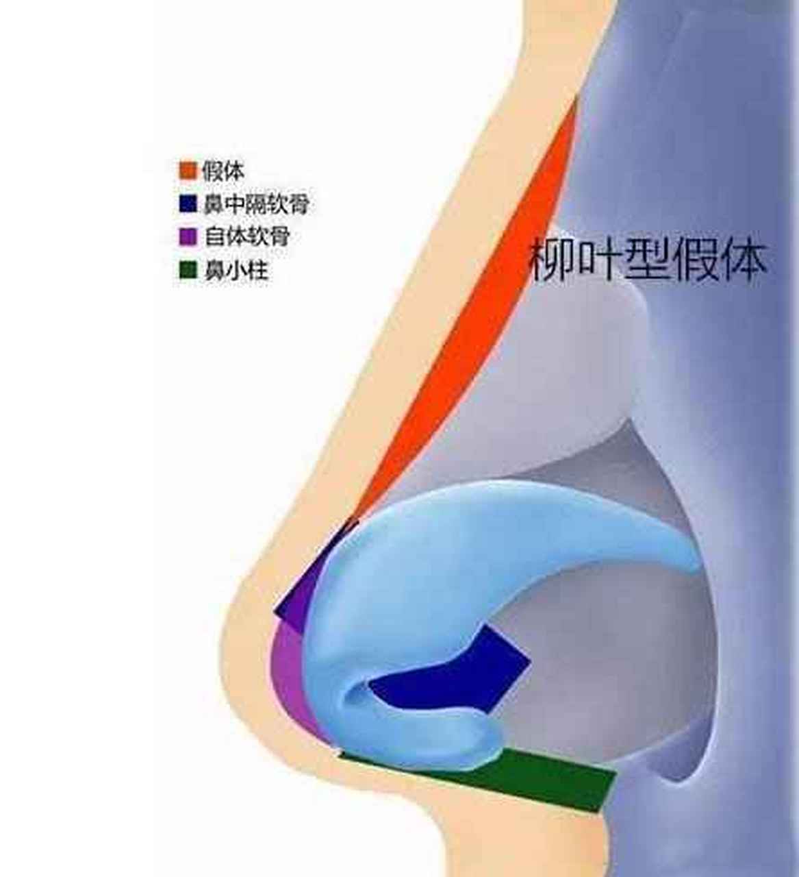 柳叶型假体图片图片